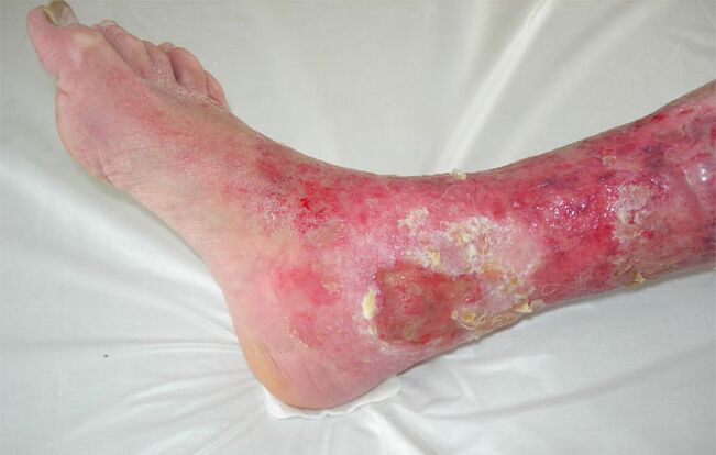ulcer