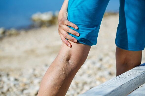 Annoying leg pain with varicose veins