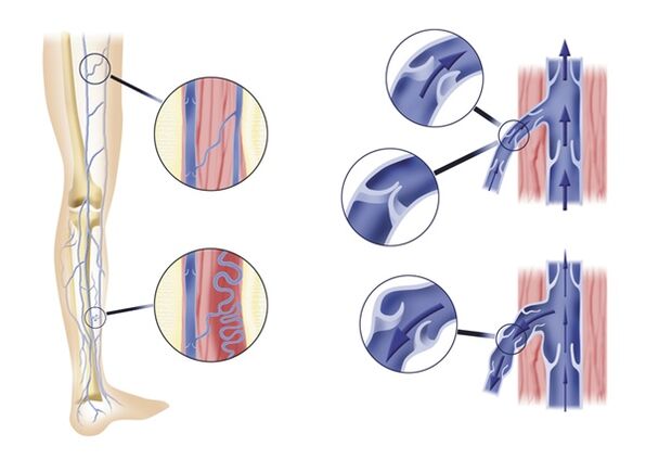 Incompetent venous valves lead to varicose veins