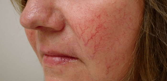 How to treat varicose veins on the face