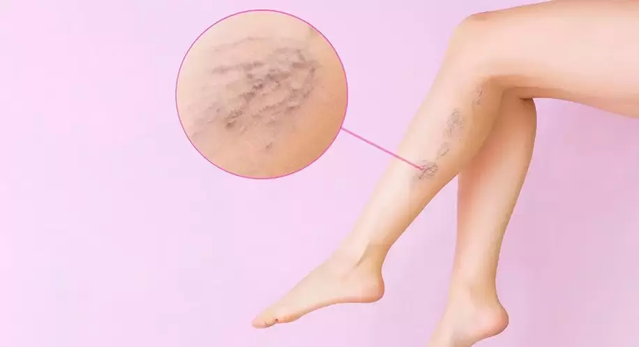 Varicose veins in the legs