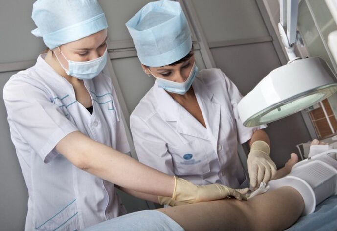 Performing surgery for varicose veins in the legs