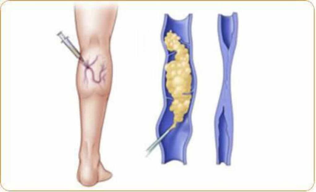 An example of the sclerotherapy procedure for varicose veins and a clear result